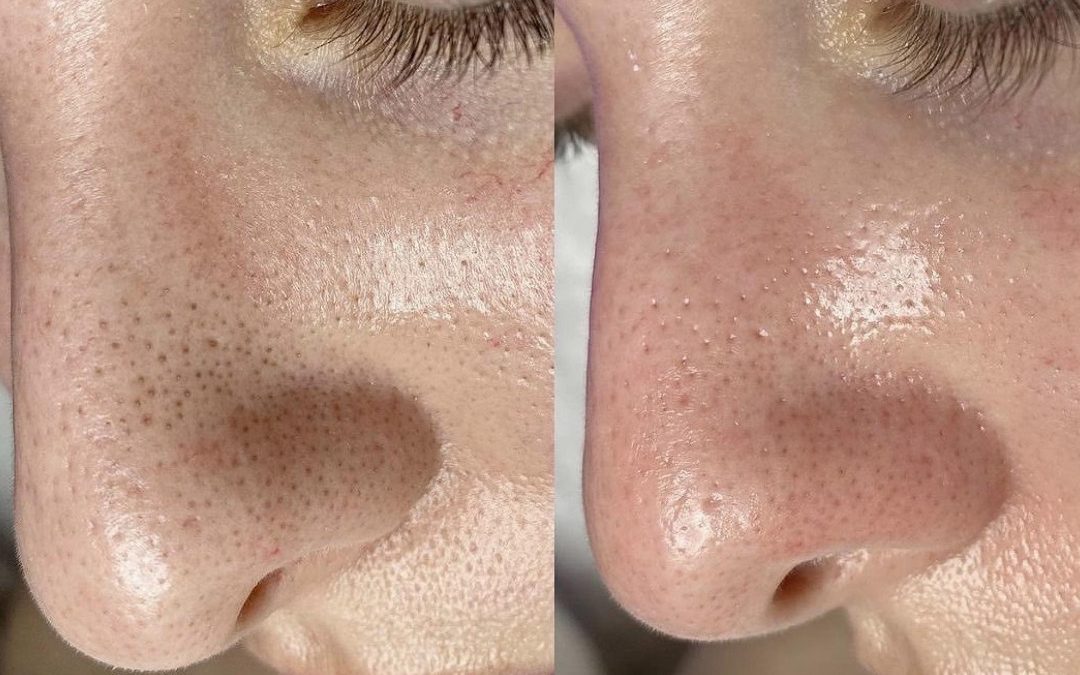 Trattamento Hydrafacial Milano