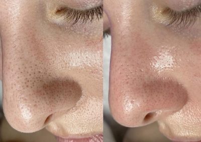Trattamento Hydrafacial Milano