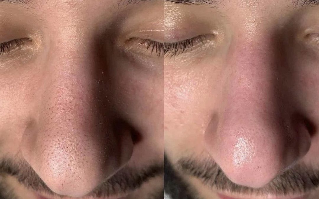 Trattamenti Viso Hydrafacial Milano
