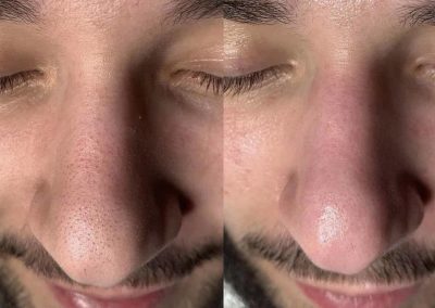 Trattamenti Viso Hydrafacial Milano