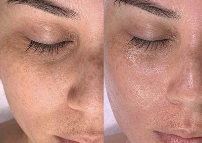 Centro Hydrafacial Milano